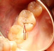潜伏虫歯　術前2